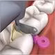 Dental Disposable Dental Plastic Wedges with Holes of CE